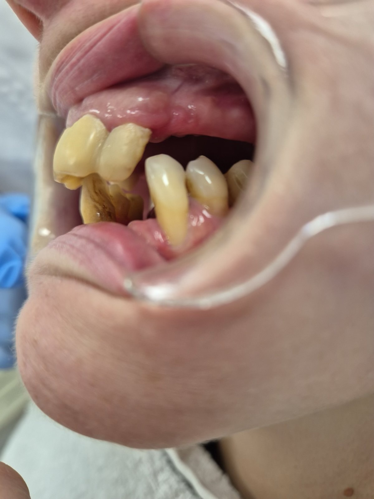 transformacija osmijeha za 7 dana u tuzli. Početno stanje pacijentice